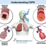 Understanding-the-impact-of-COPD-on-lungs