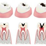 stages-of-tooth-cavitie-development