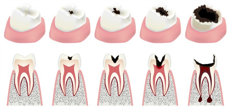 Cavity Development 