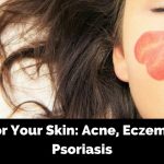 CBD for Your Skin: Acne, Eczema, and Psoriasis