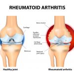 CBD-for-rheumatoid-arthritis