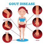 cbd-for-gout-disease
