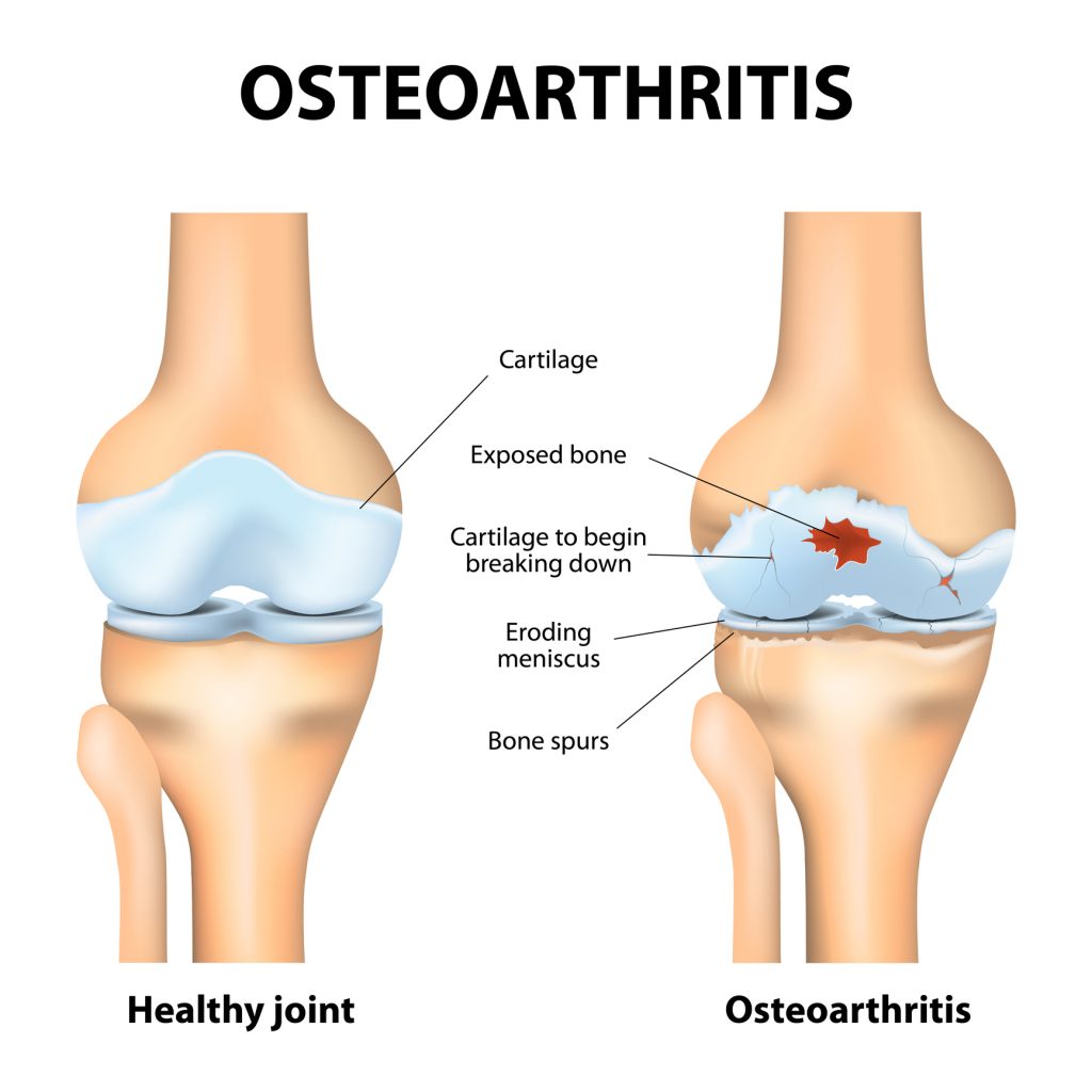 Treating Osteoarthritis with CBD