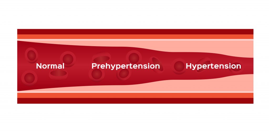 Hypertension graphic