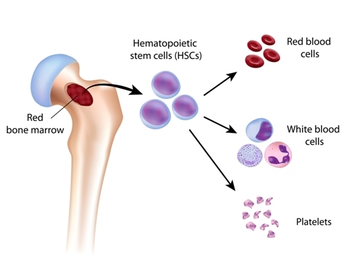 Bone Marrow Transplant for Sickle Cell