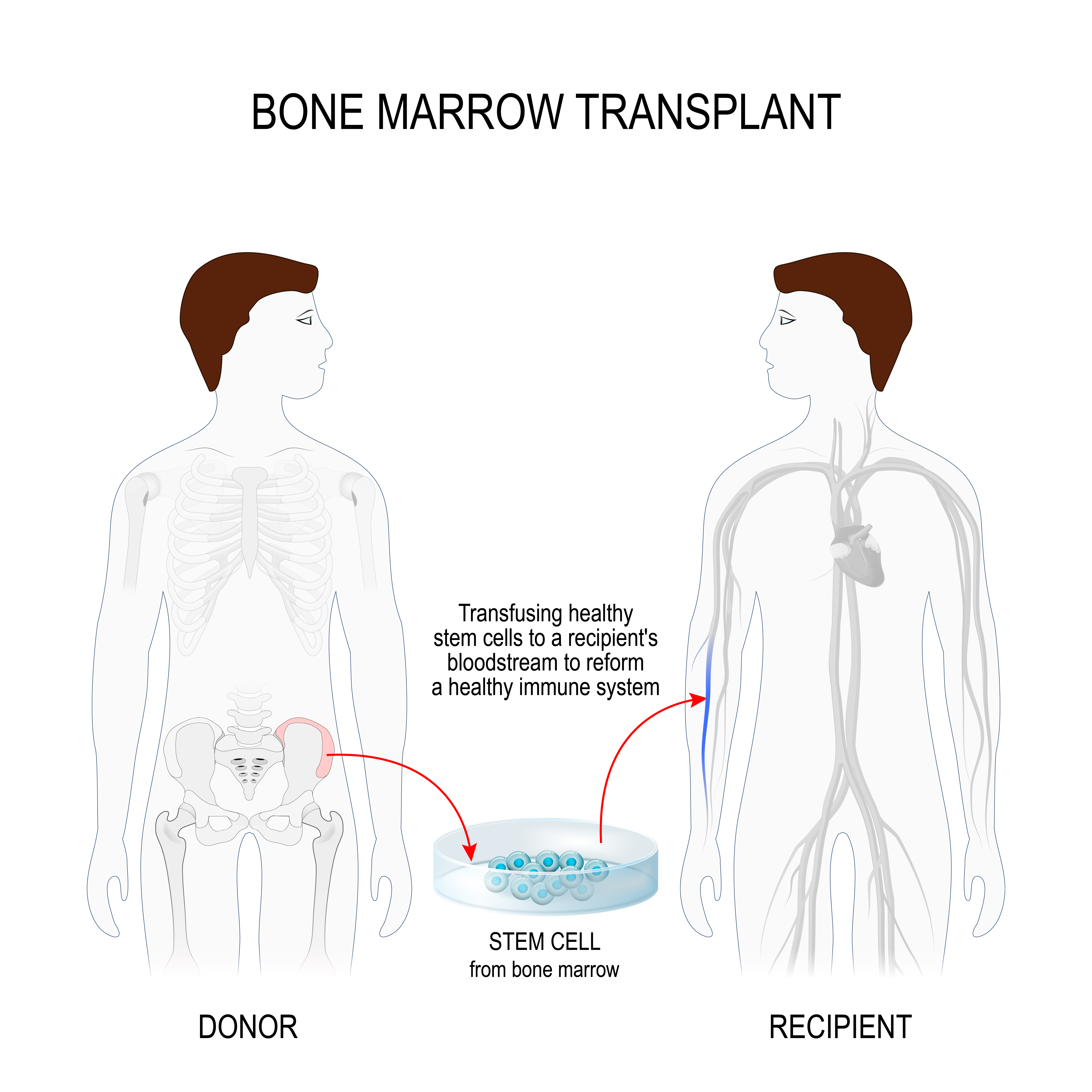 Bone Marrow for Sickle Cell