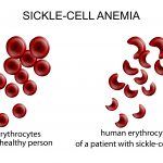 CBD for Sickle Cell