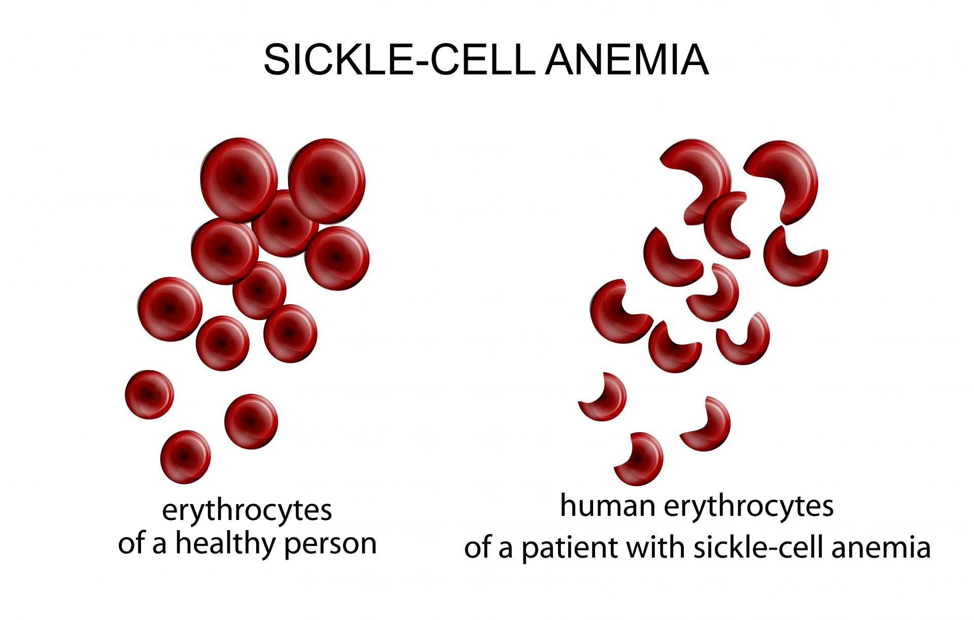 CBD Shown To Be An Effective Sickle Cell Treatment Cannabidiol